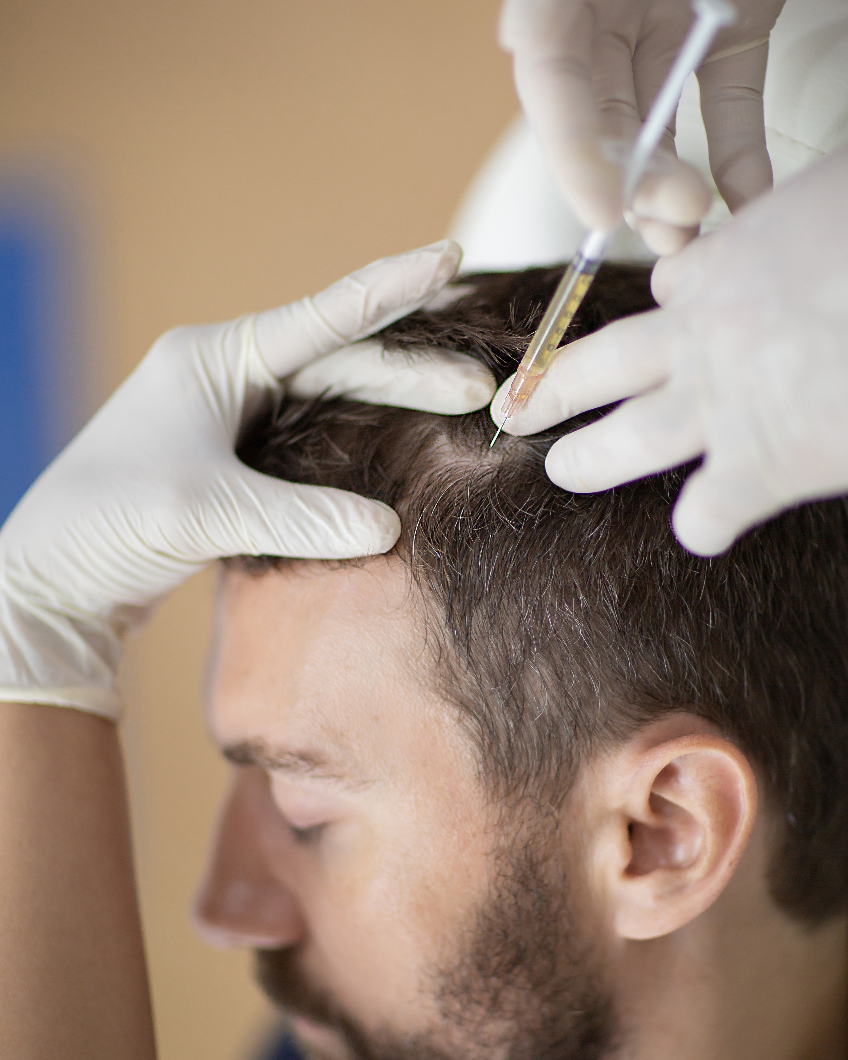 Growth Factor Concentrate GFC Hair Therapy Session