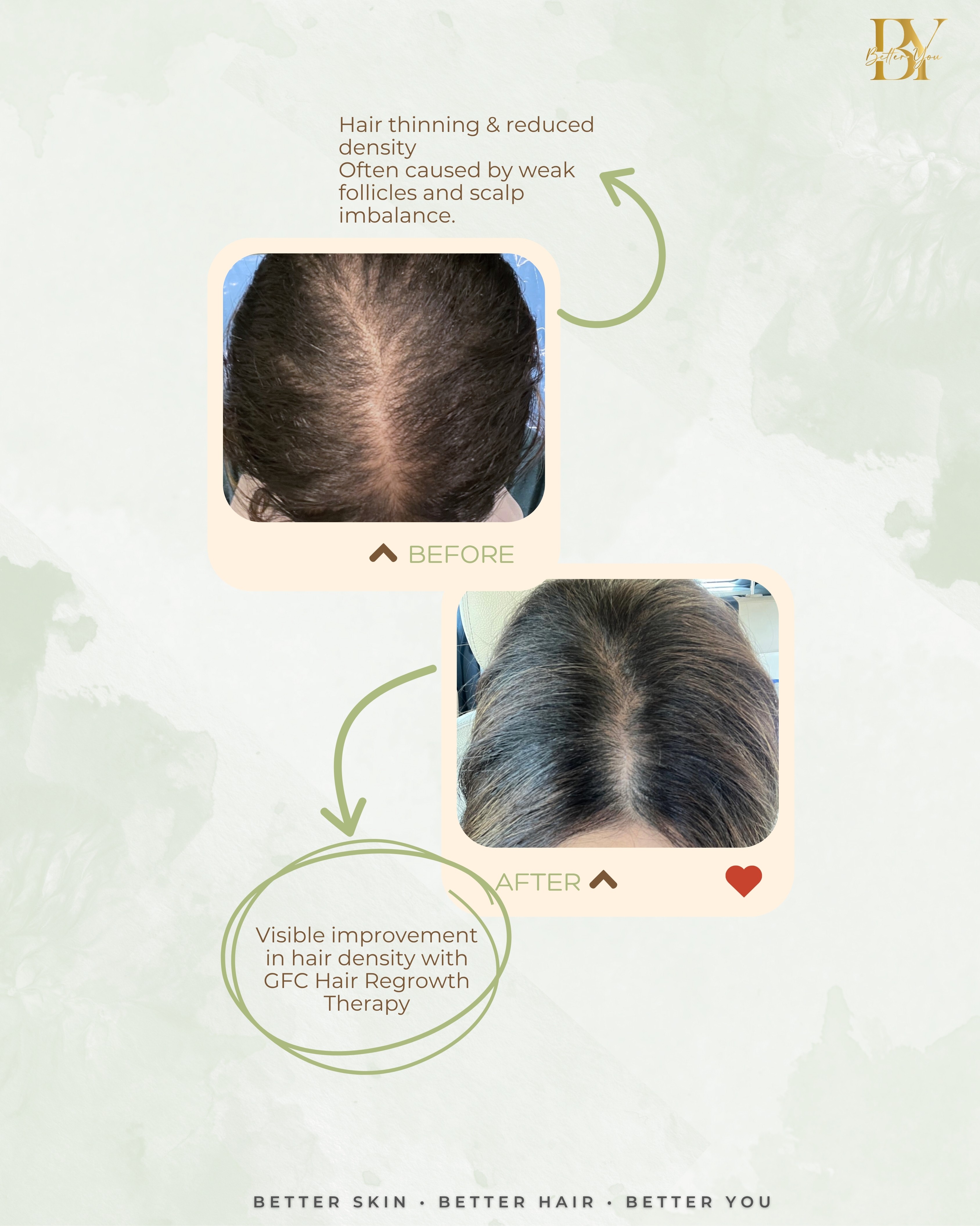 Clinical Presentation Hair Growth Treatments PRP and GFC