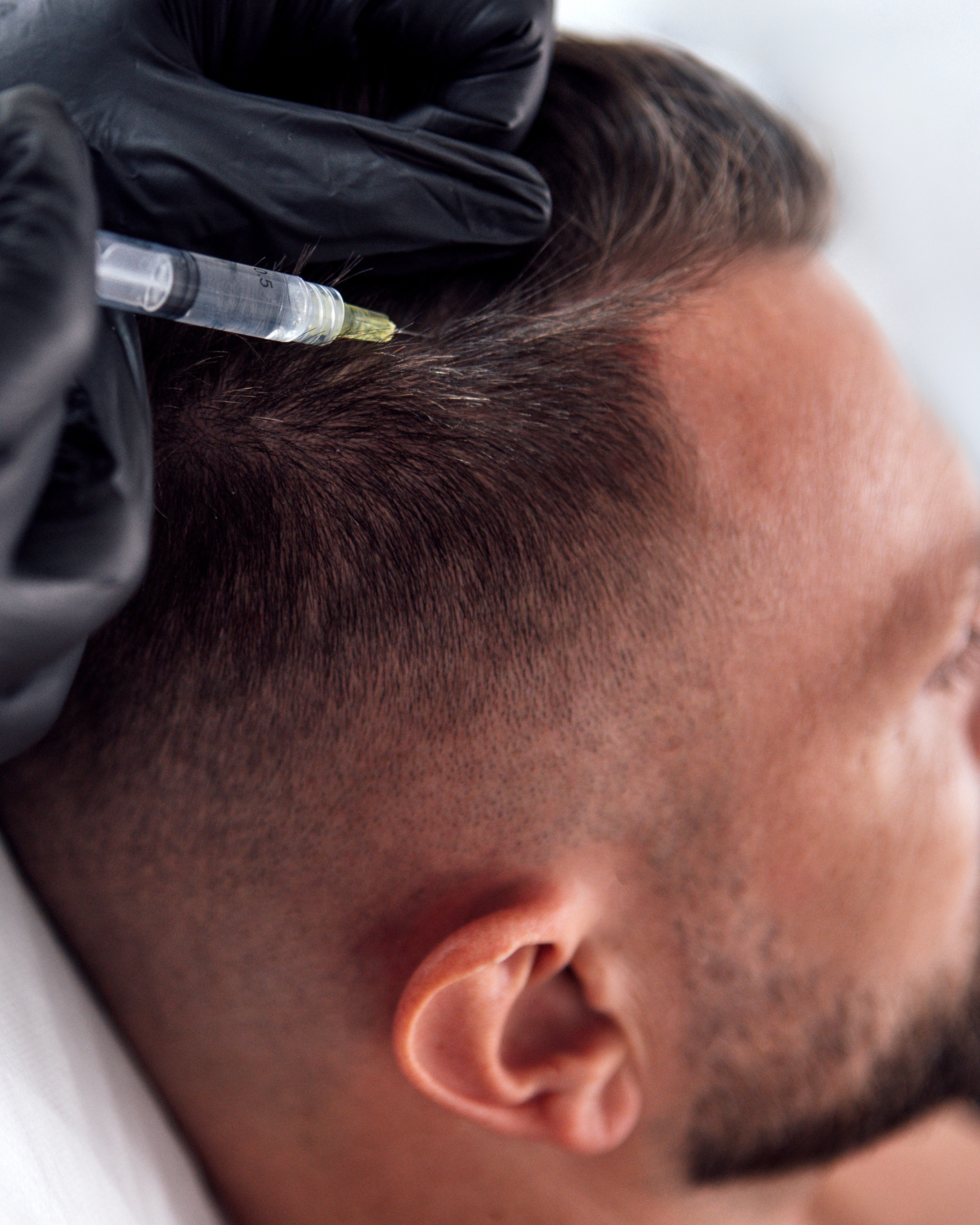 Exosome Cellular Hair Signal Regeneration Therapy